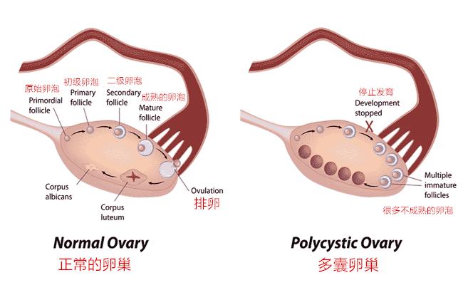 正常卵巢和多囊卵巢比较.jpg