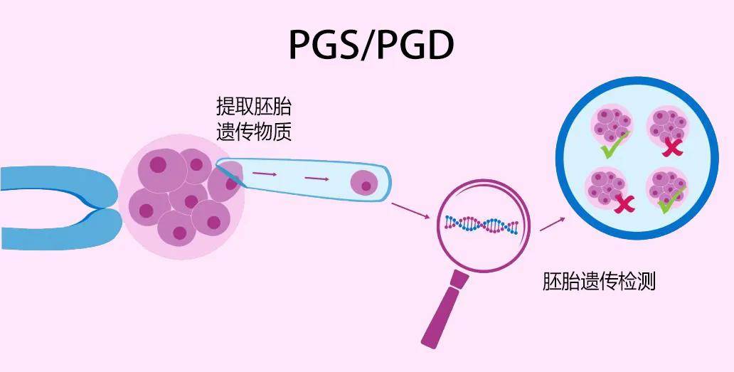 PGS/PGD植入前遗传学筛查和诊断技术.jpg